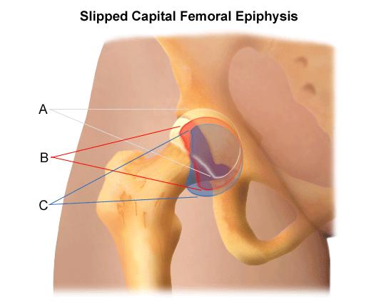 Slipped epiphysis.JPG